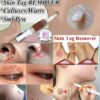 Skin Tag Remover