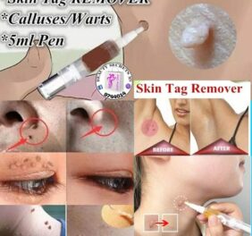 Skin Tag Remover