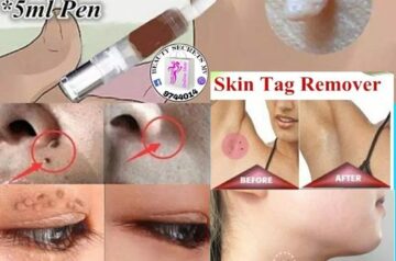 Skin Tag Remover